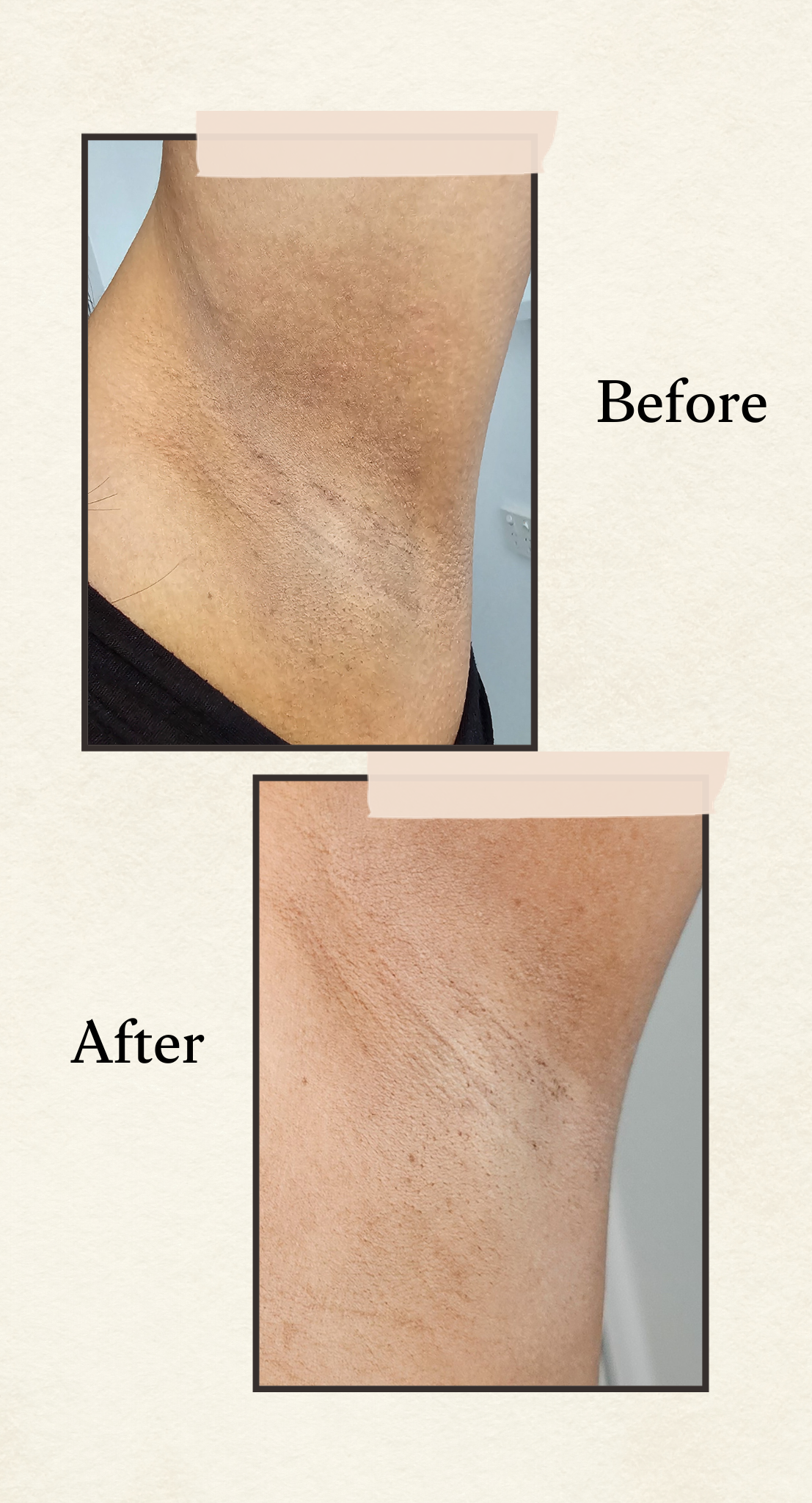 Before and after comparison showing skin brightening result on underarm area, with the words 'Before' and 'After' on a light beige background.