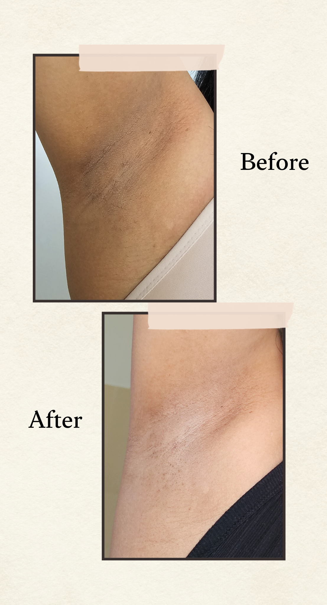Before and after comparison showing a close-up of underarm brightening results, with the top panel labeled 'Before' and the bottom panel labeled 'After' on a light beige background.
